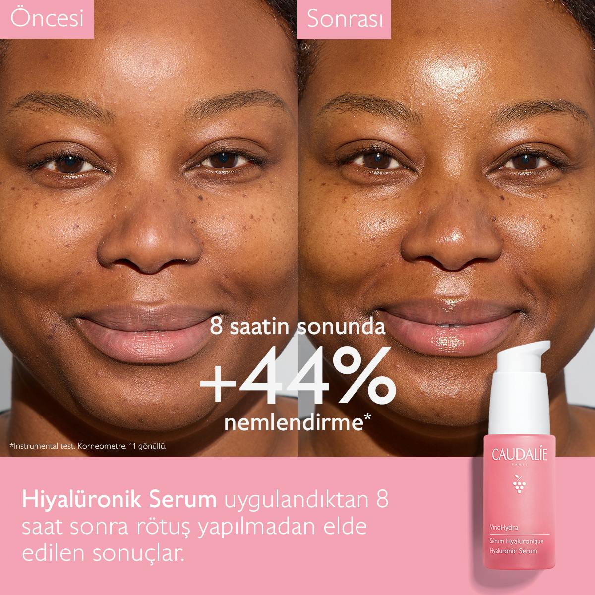 Hiyalüronik Serum Before After